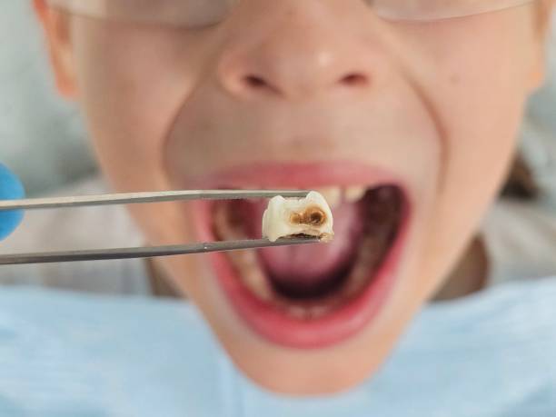 Best Emergency Broken Tooth Repair in Westview, FL